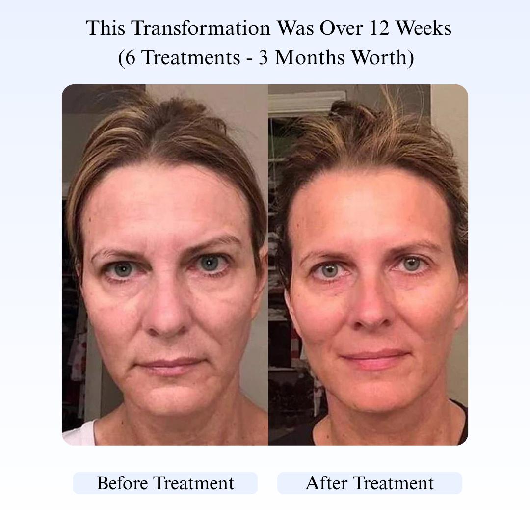 Micro-Infusion Skincare Treatment (For Dark Spots & Wrinkles)
